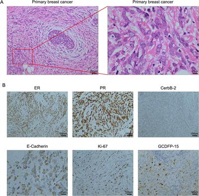 Small intestinal metastasis from primary breast cancer: a case report and review of literature